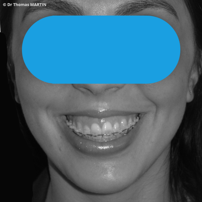 Chirurgie Bimaxillaire : Correction d'un sourire gingival