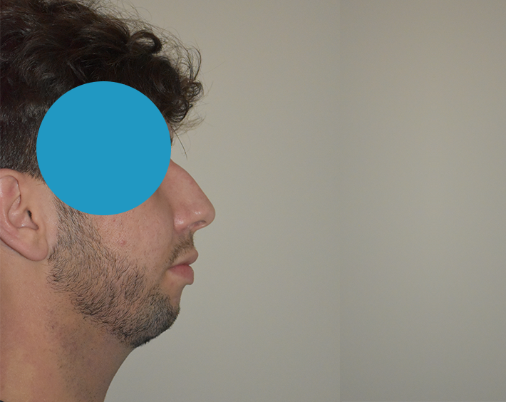 Avant Profiloplastie