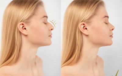 Existe-t-il des chirurgiens spécialisés uniquement en rhinoplastie à Lyon ?