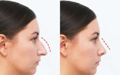 Rhinoplastie à Lyon : quel rôle joue l&rsquo;accompagnement psychologique avant et après l’opération ?