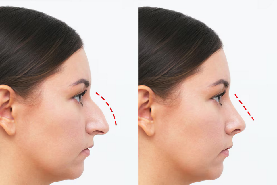 Opération du Nez Lyon