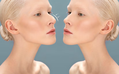 Rhinoplastie à Lyon : recommandations alimentaires avant et après l’opération