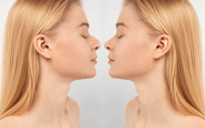 Peut-on corriger une bosse du nez sans chirurgie grâce à des alternatives à la rhinoplastie à Lyon ?