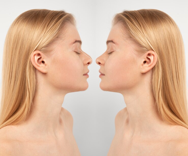 rhinoplastie avant-après Lyon 
