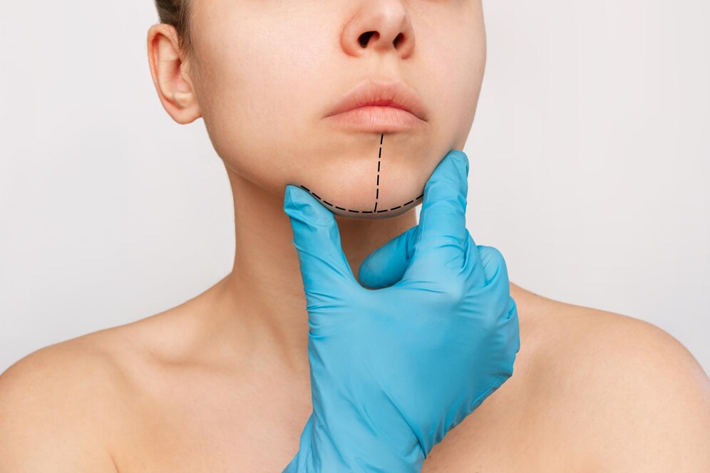 chirurgie du menton lyon