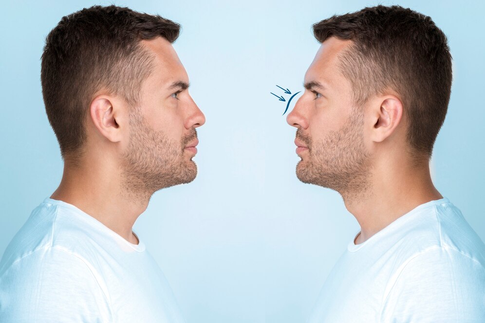 rhinoplastie avant-après Lyon