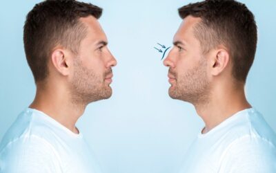 Quelle est la durée moyenne de l’intervention pour une rhinoplastie à Lyon sous anesthésie générale ?