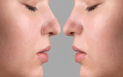 Quels types d’anesthésie sont utilisés lors d’une rhinoplastie à Lyon ?