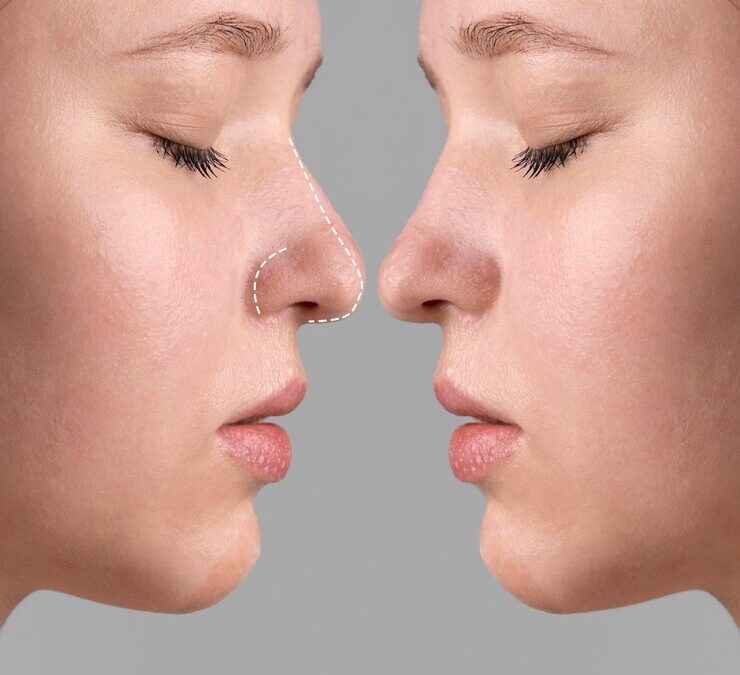 rhinoplastie lyon