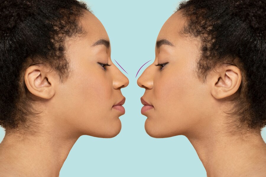 rhinoplastie avant-après Lyon