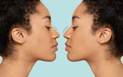 Chirurgie nasale à Lyon : quelles sont les différentes options proposées ?