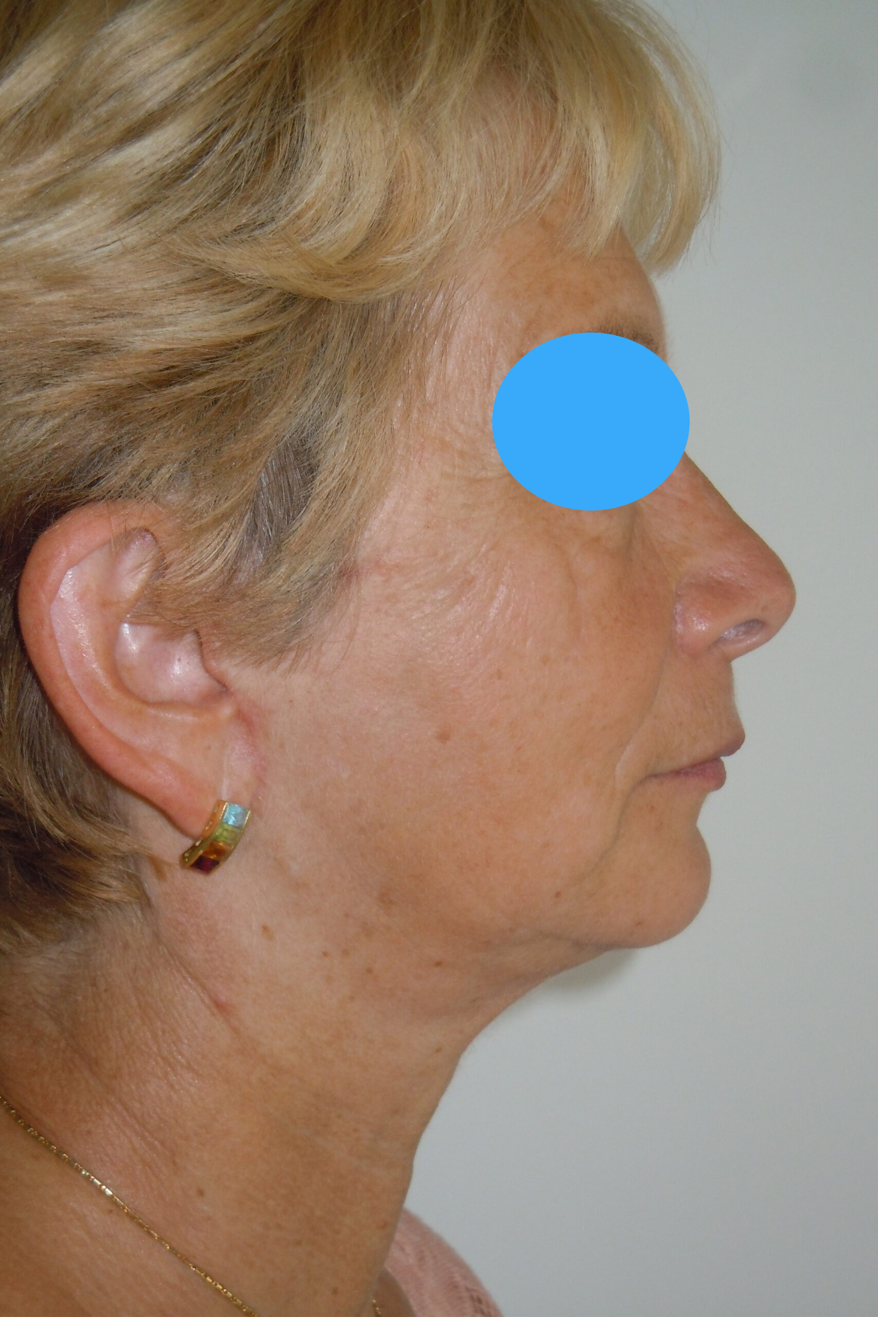 Après Rhinoplastie