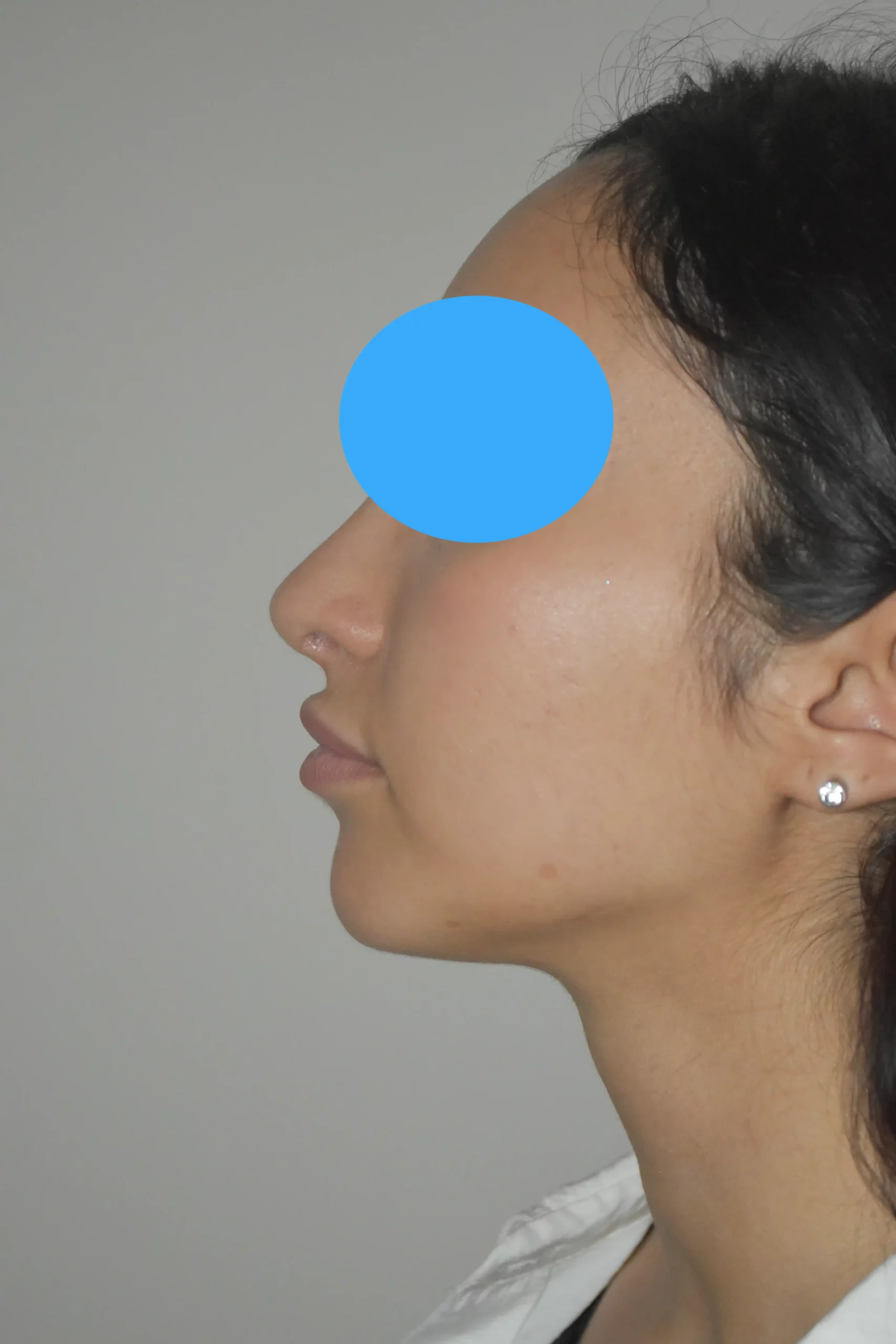 Après rhinoplastie du nez dévier