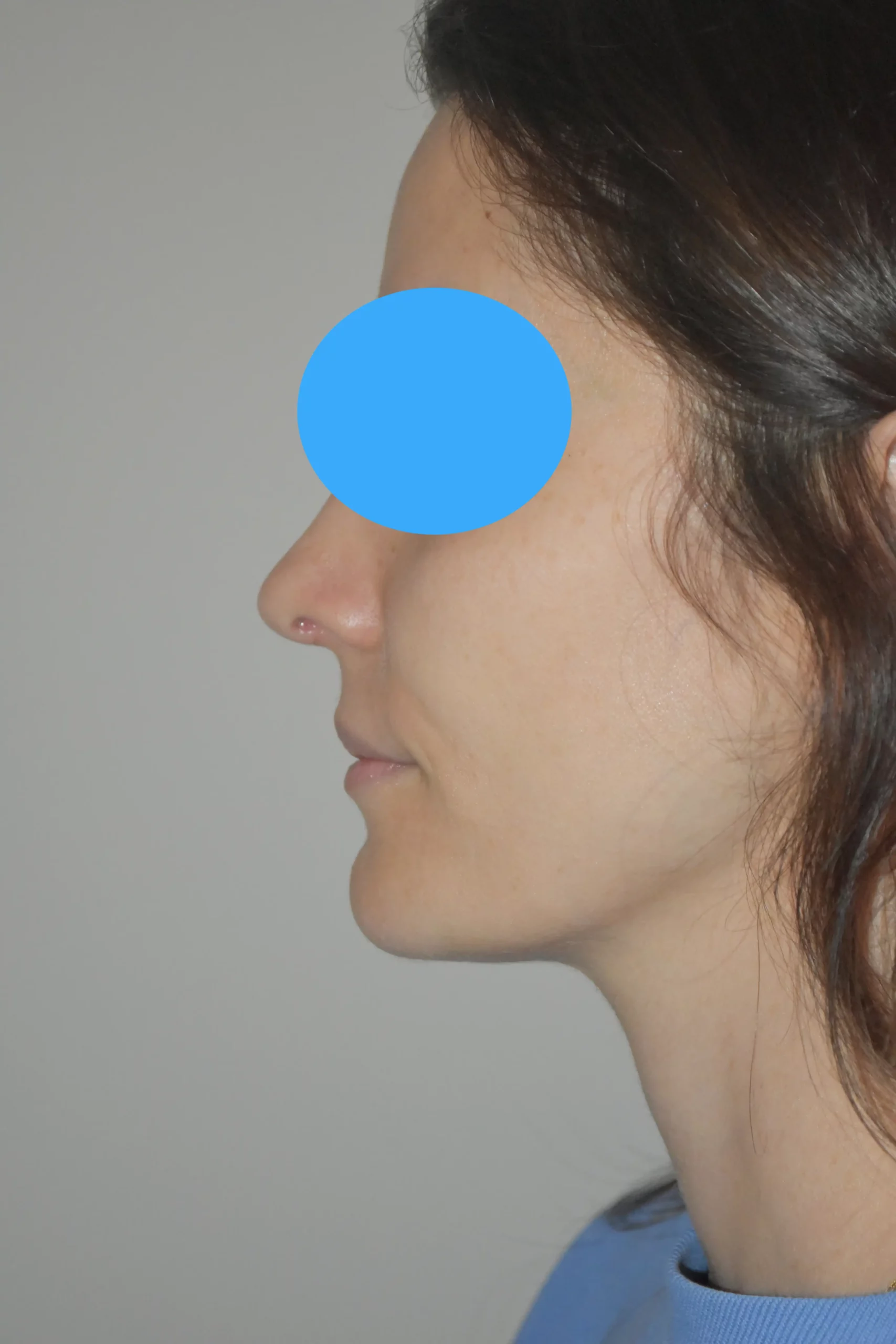 Après rhinoplastie
