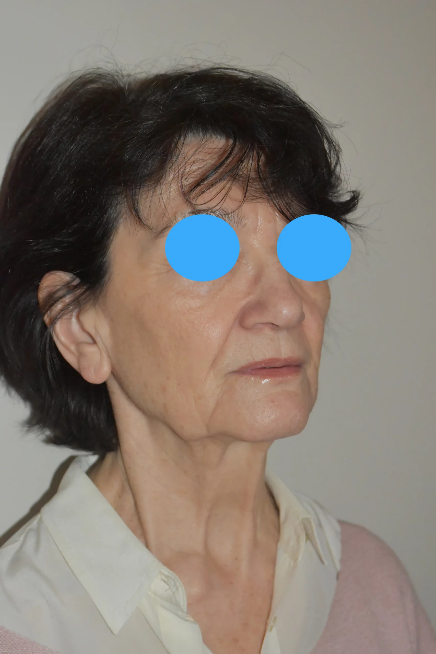 Avant Profiloplastie