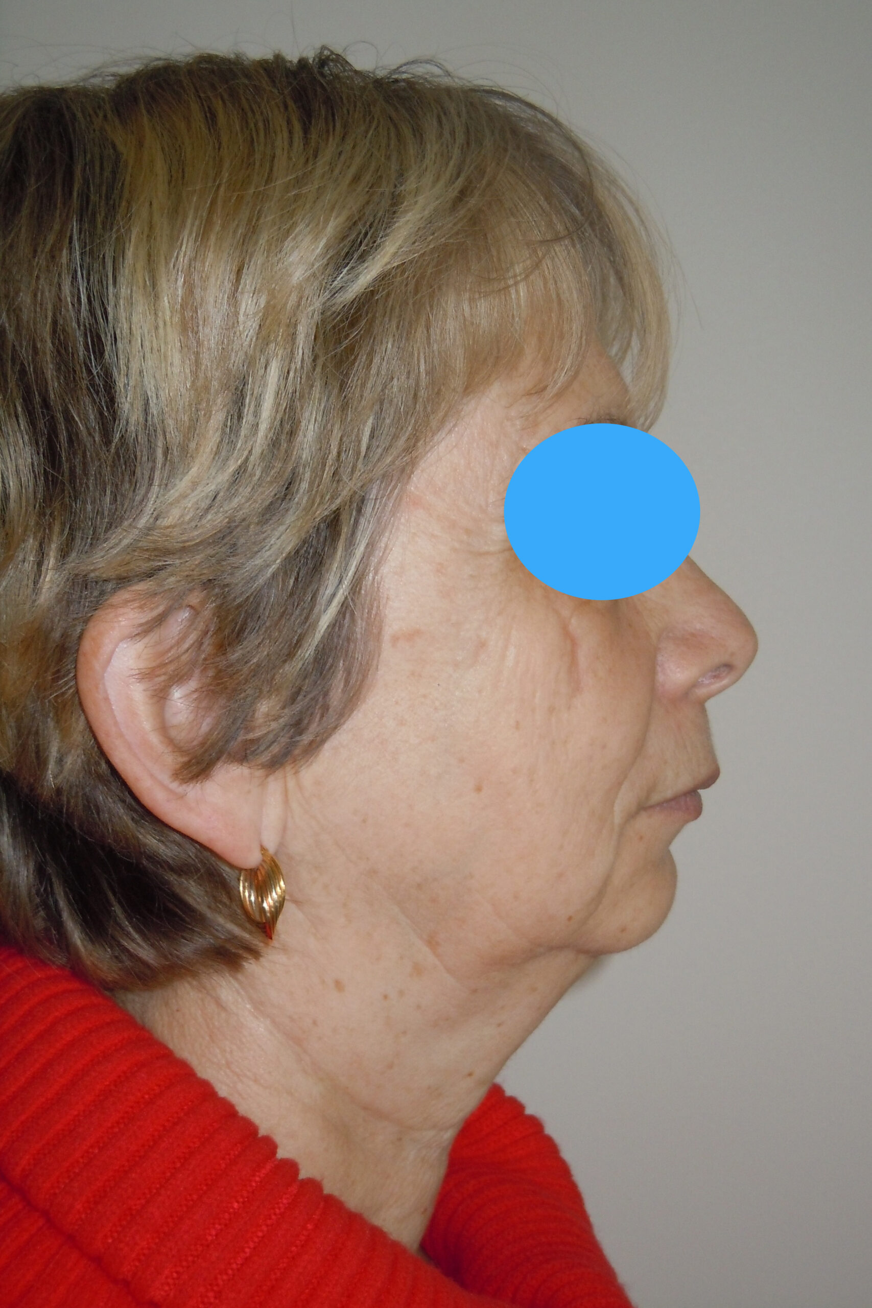 avant Rhinoplastie
