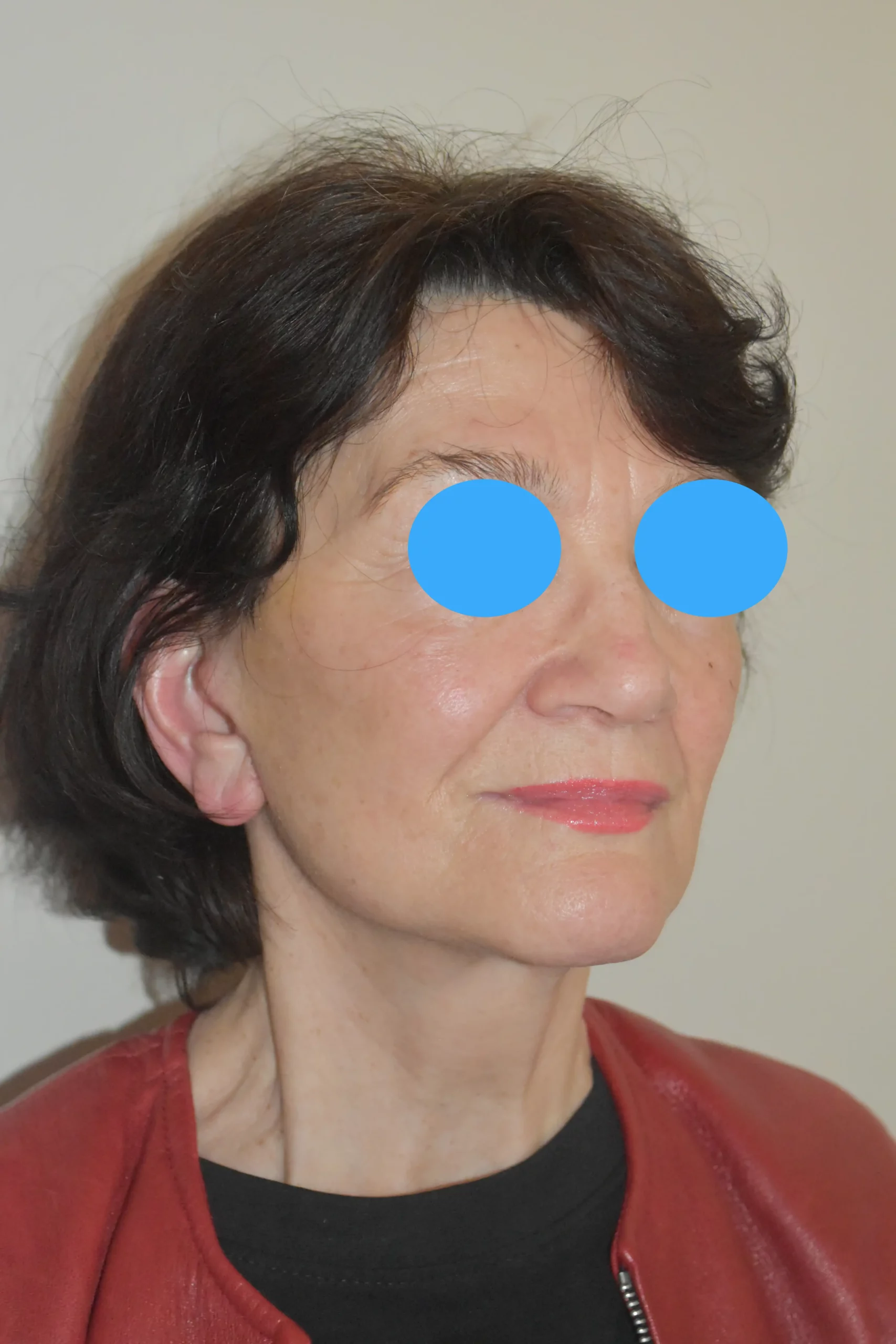 Après Profiloplastie