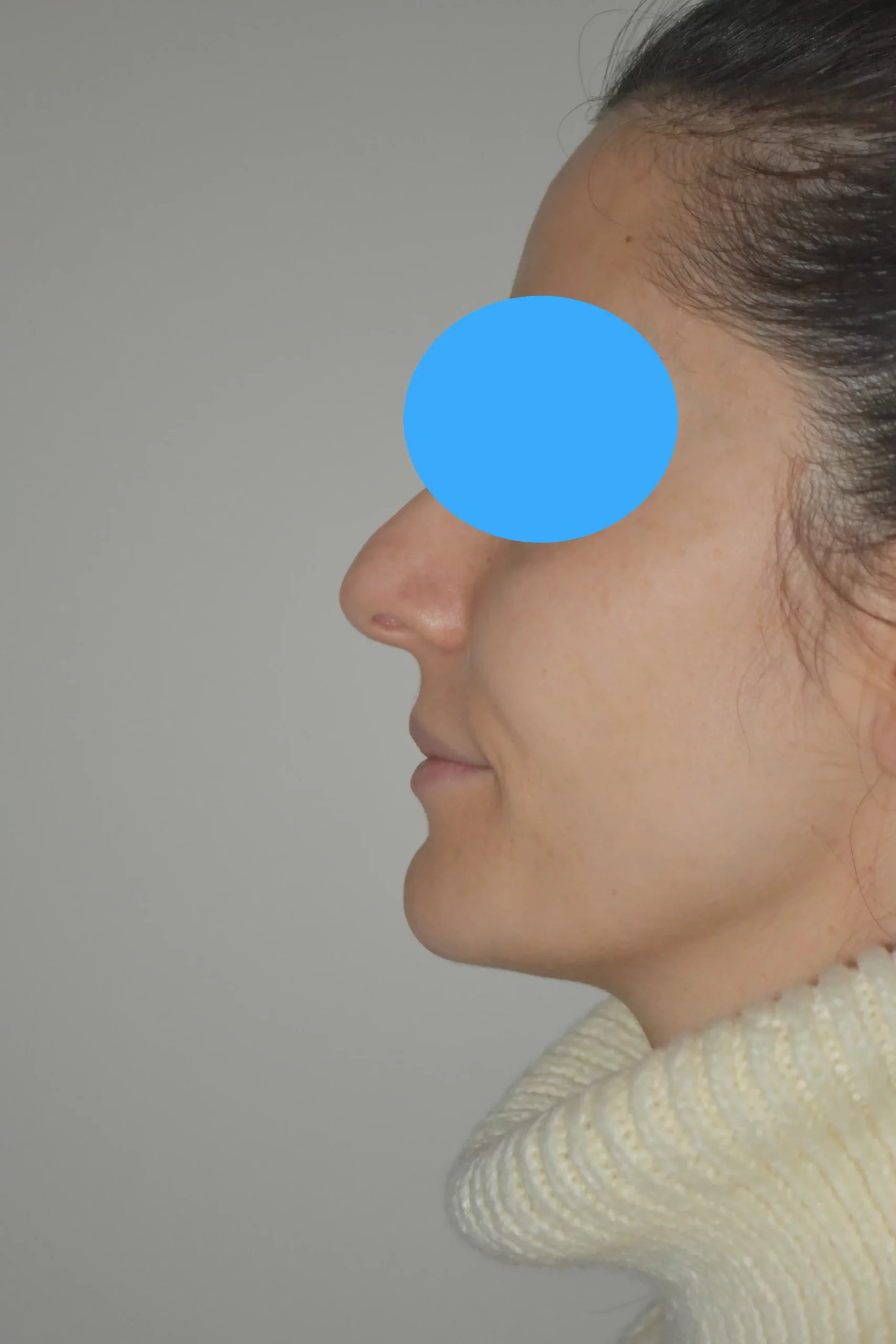 Avant rhinoplastie