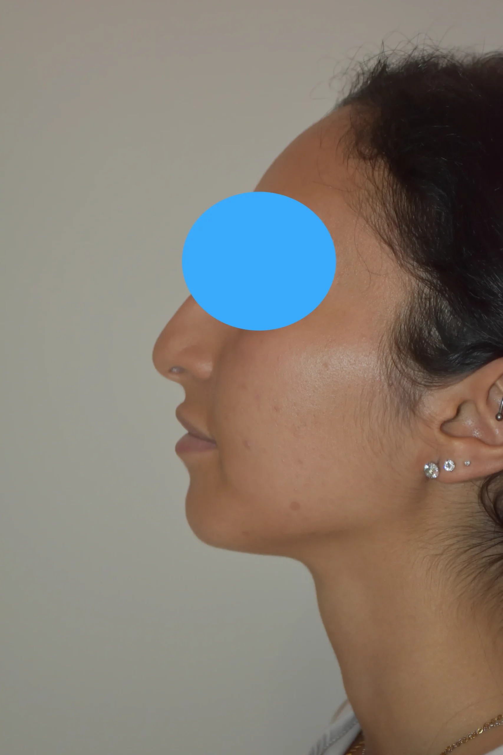 Avant rhinoplastie du nez dévier