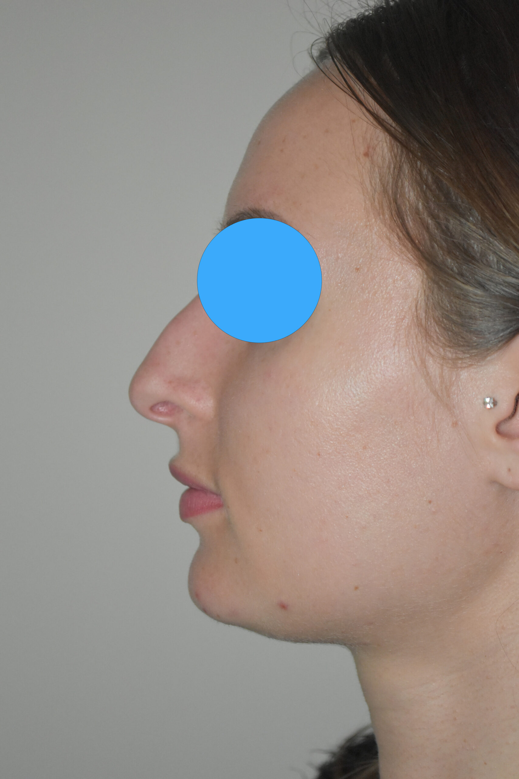 Avant rhinoplastie