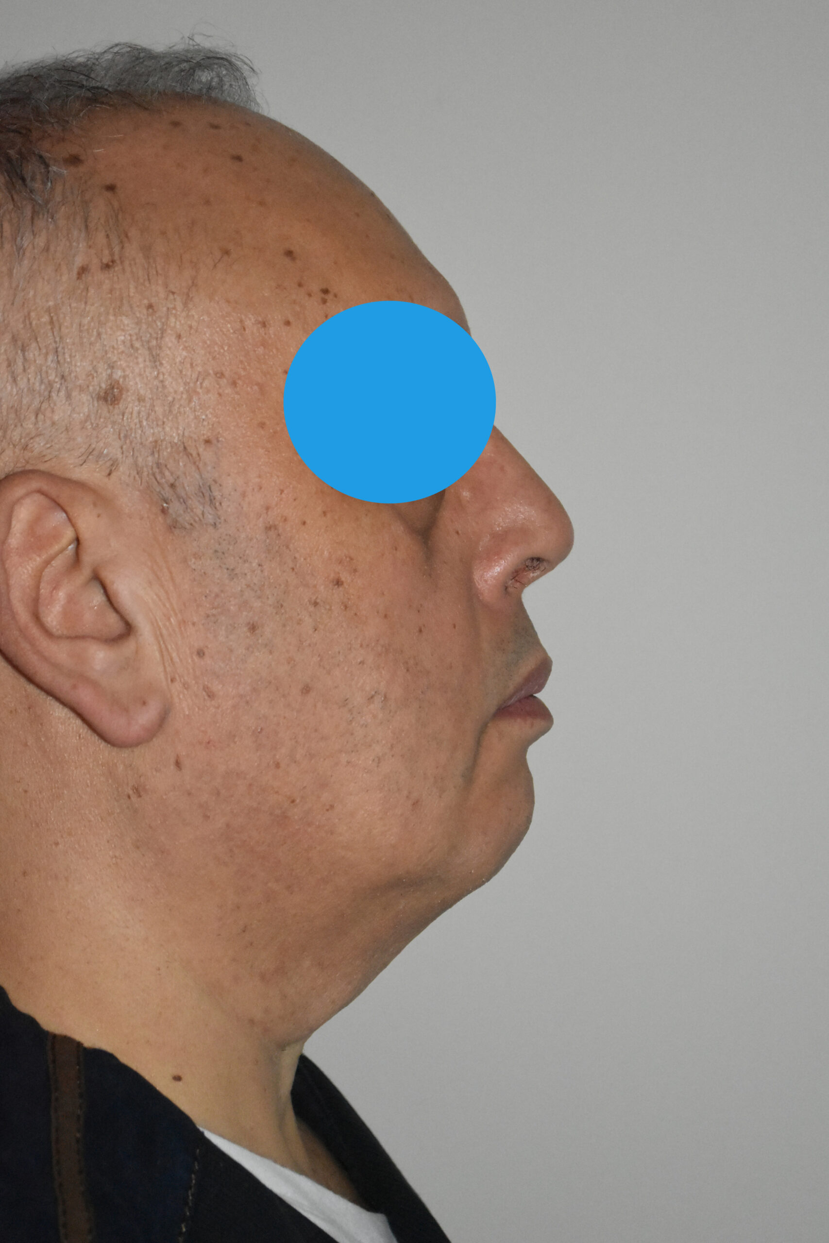 avant Rhinoplastie