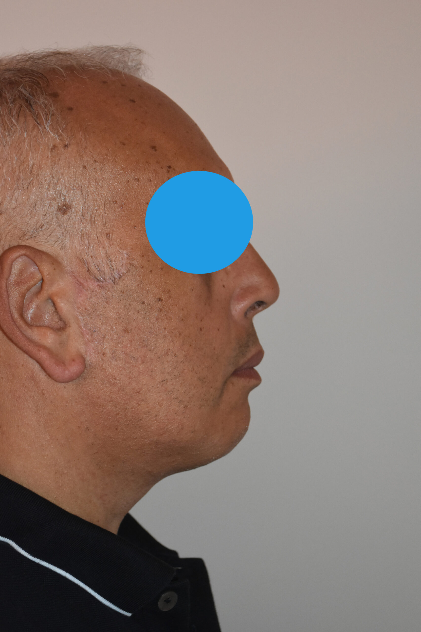 Après Rhinoplastie