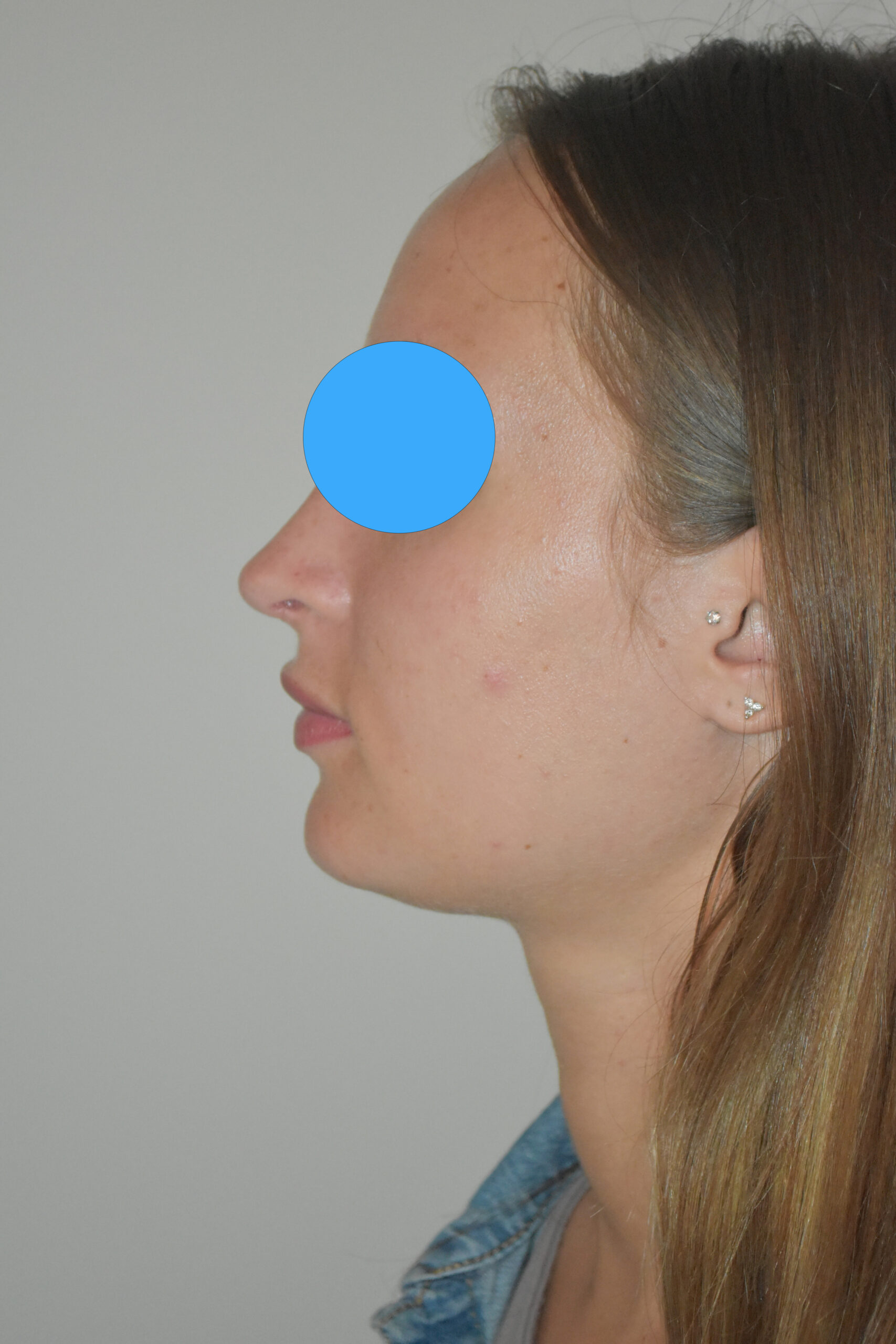 Après rhinoplastie