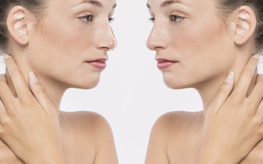 Rhinoplastie à Lyon