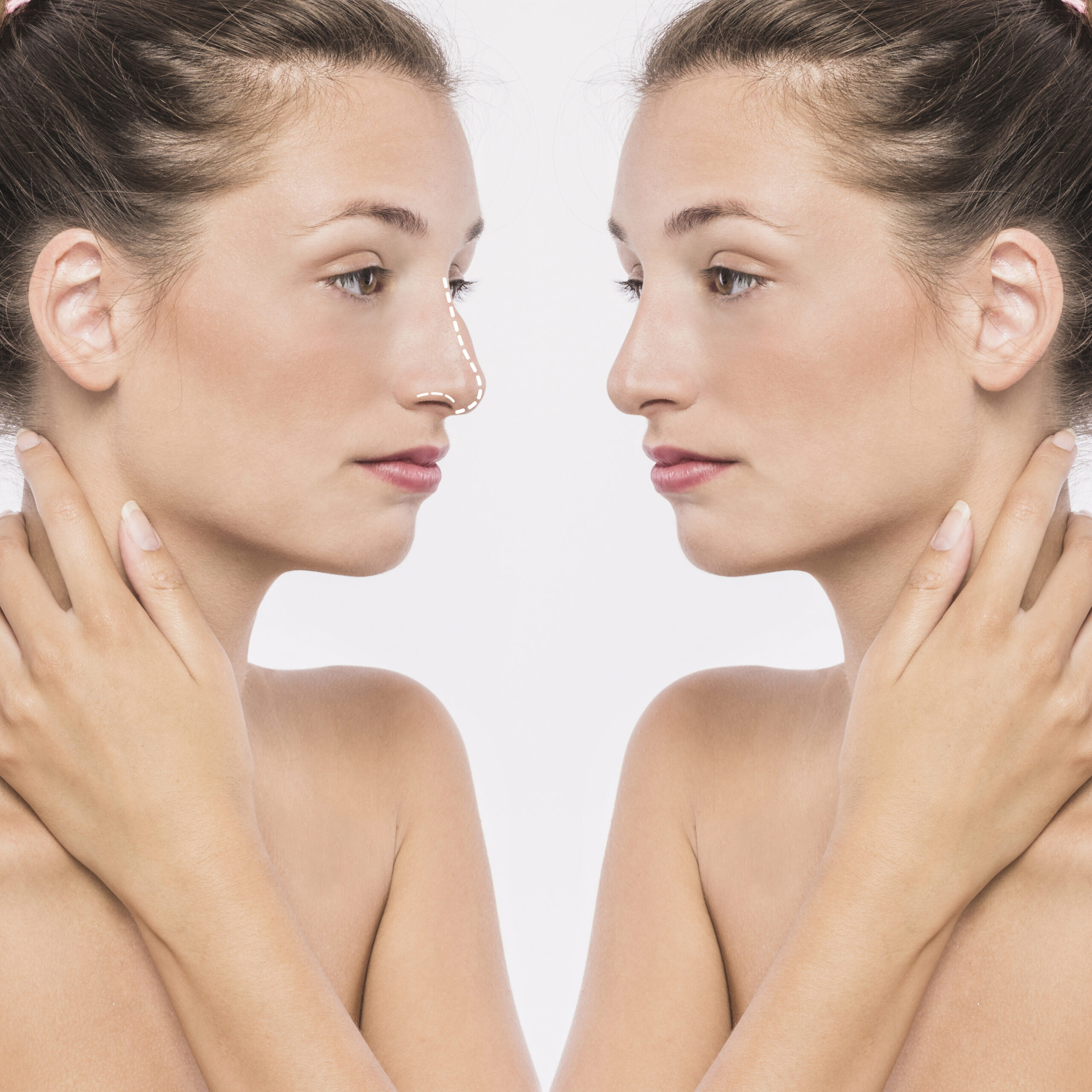 Rhinoplastie à Lyon