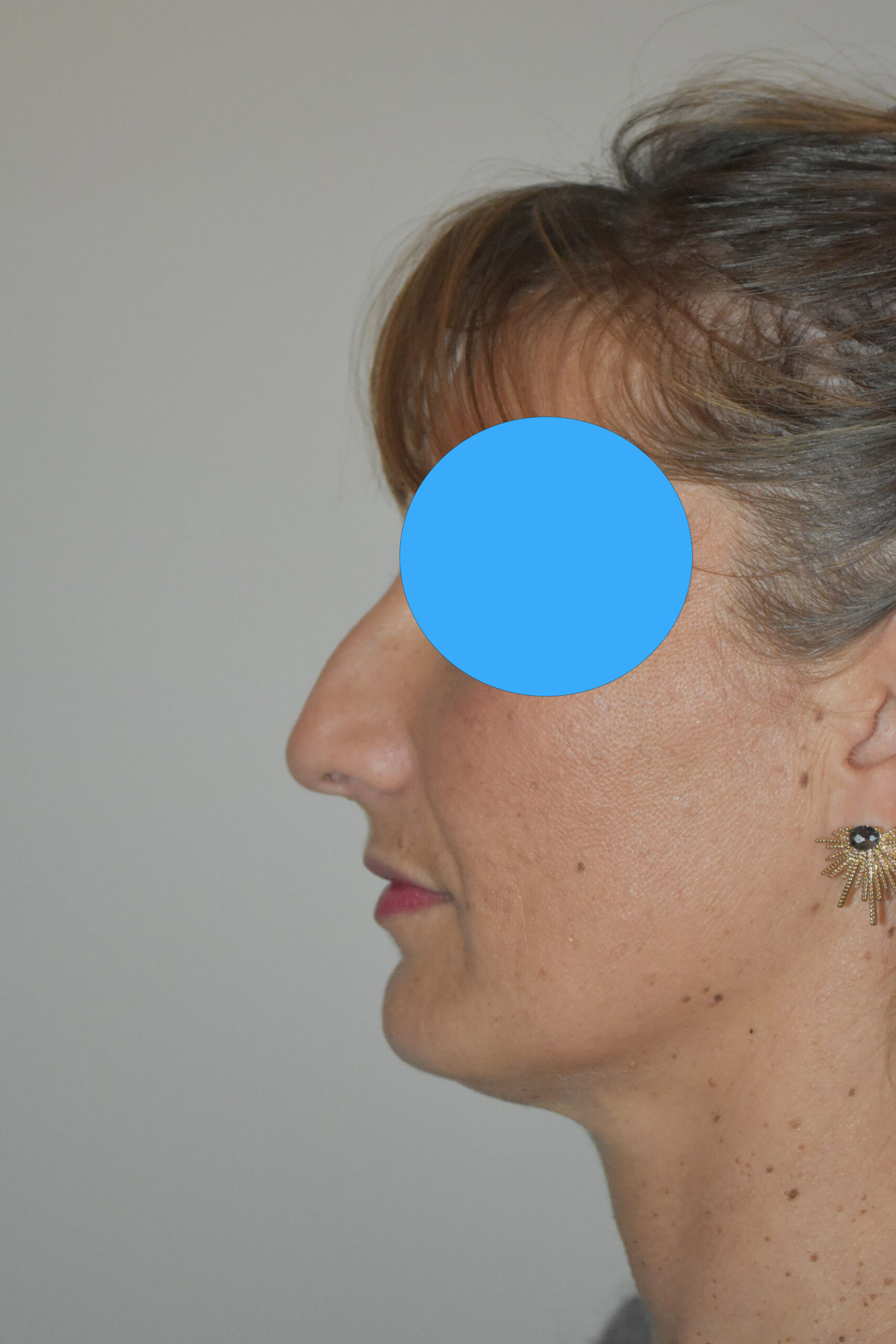 Avant rhinoplastie du nez dévier