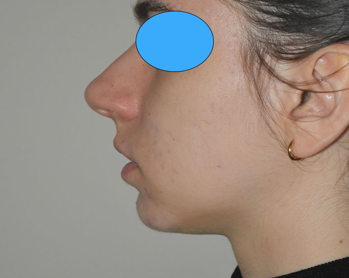 Avant Profiloplastie