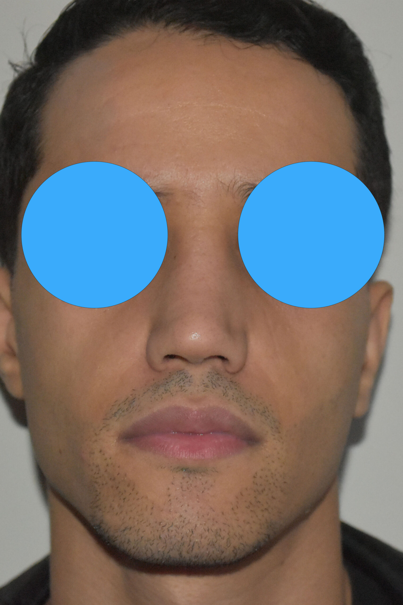 Après rhinoplastie du nez dévier