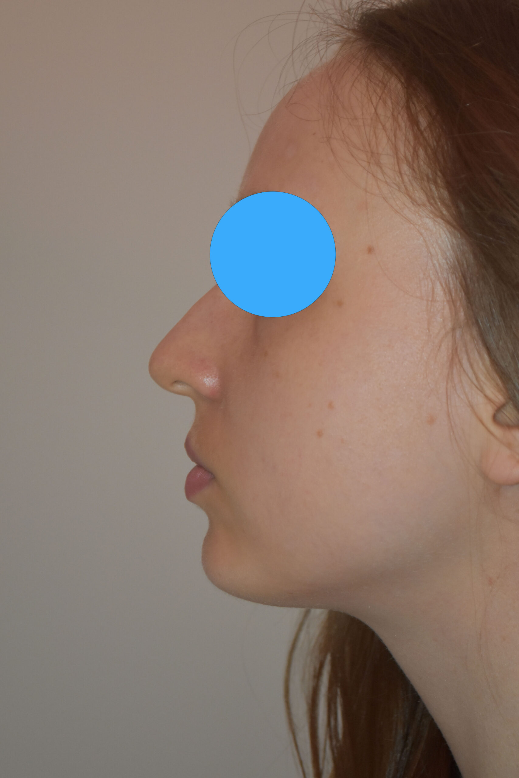Avant rhinoplastie du nez dévier