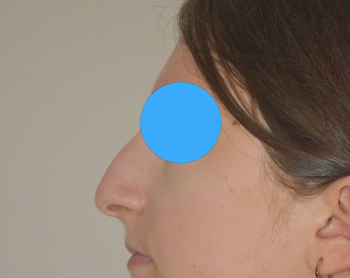 Avant Profiloplastie