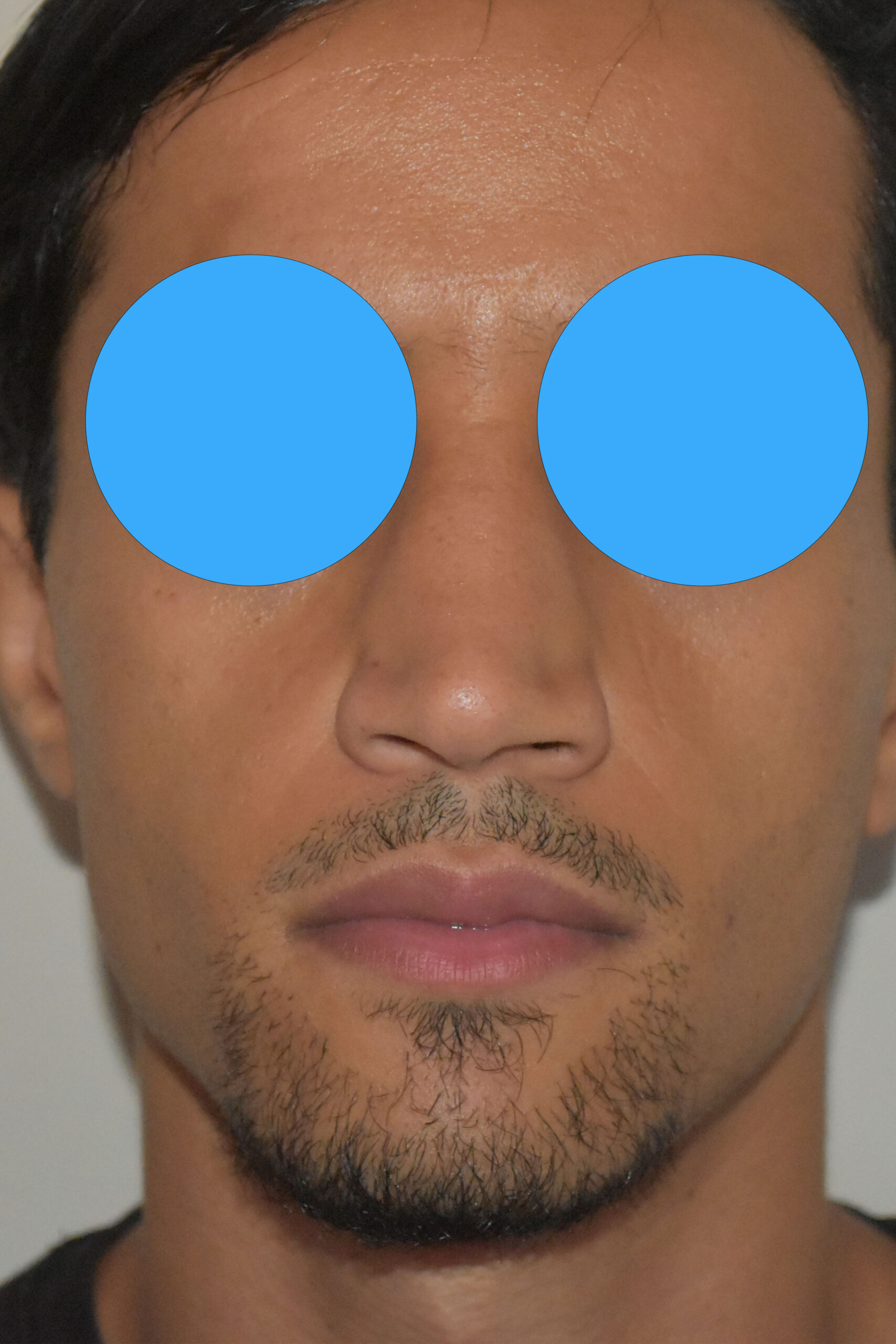 Avant rhinoplastie du nez dévier