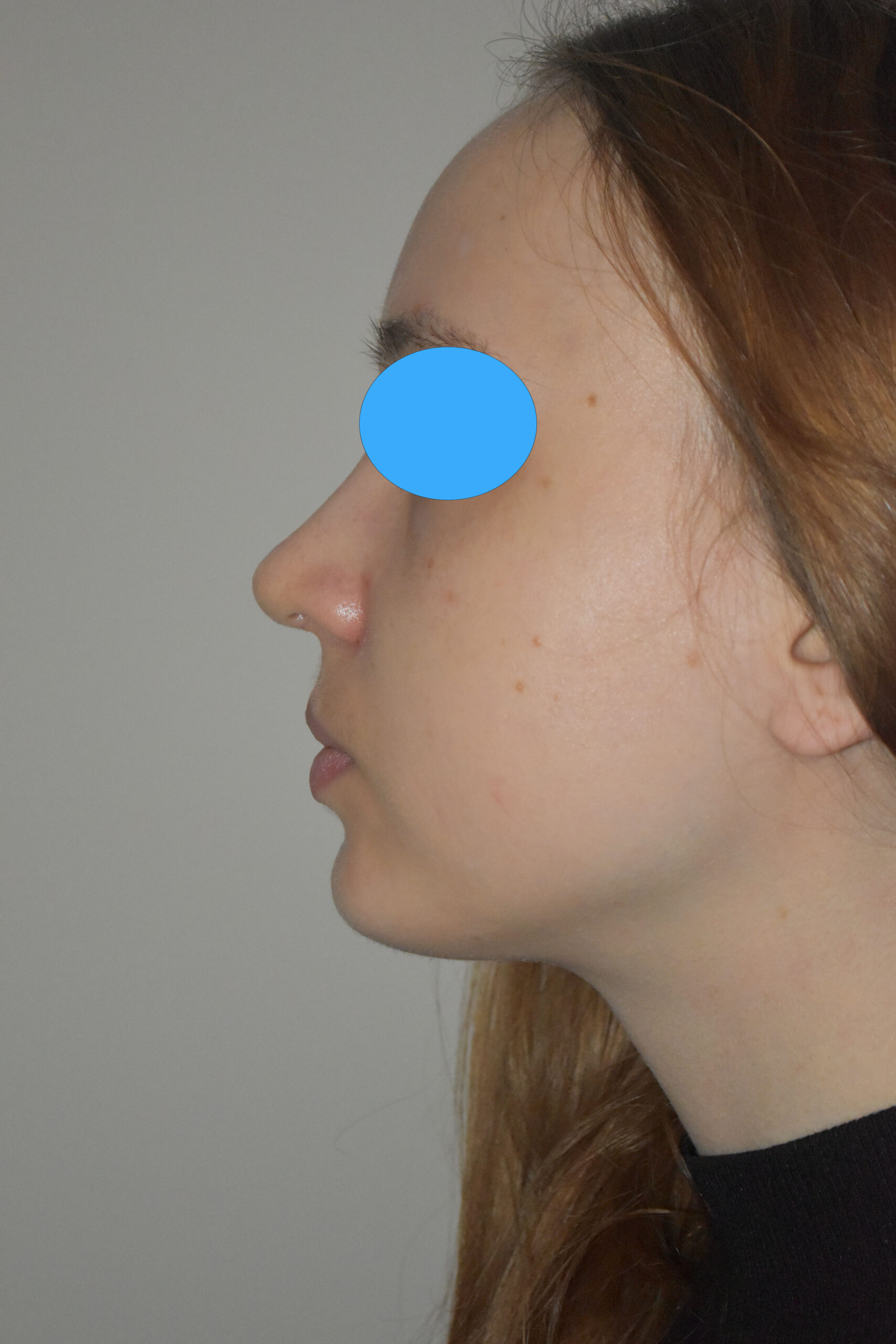 Après rhinoplastie du nez dévier
