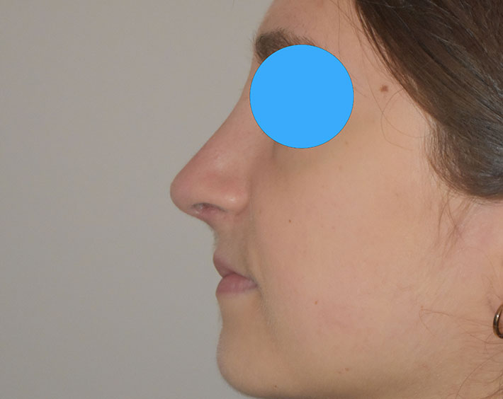 Après Profiloplastie