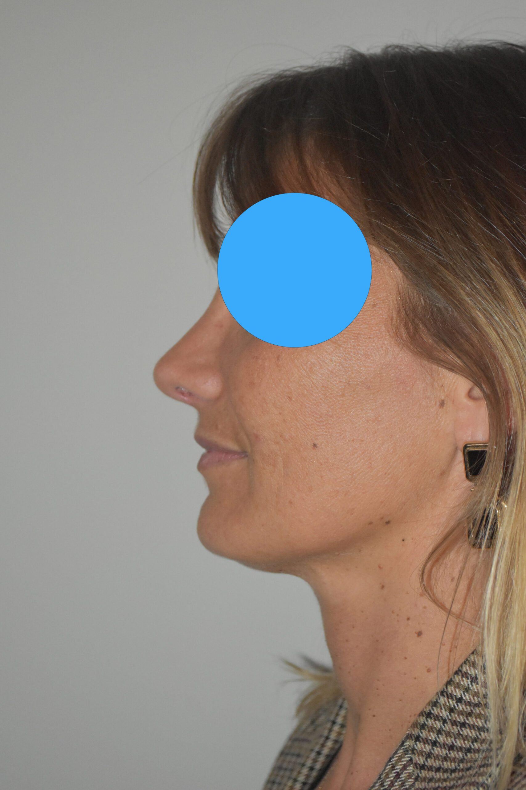 Après rhinoplastie du nez dévier