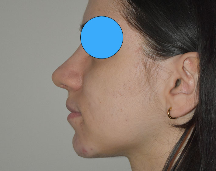 Après Profiloplastie