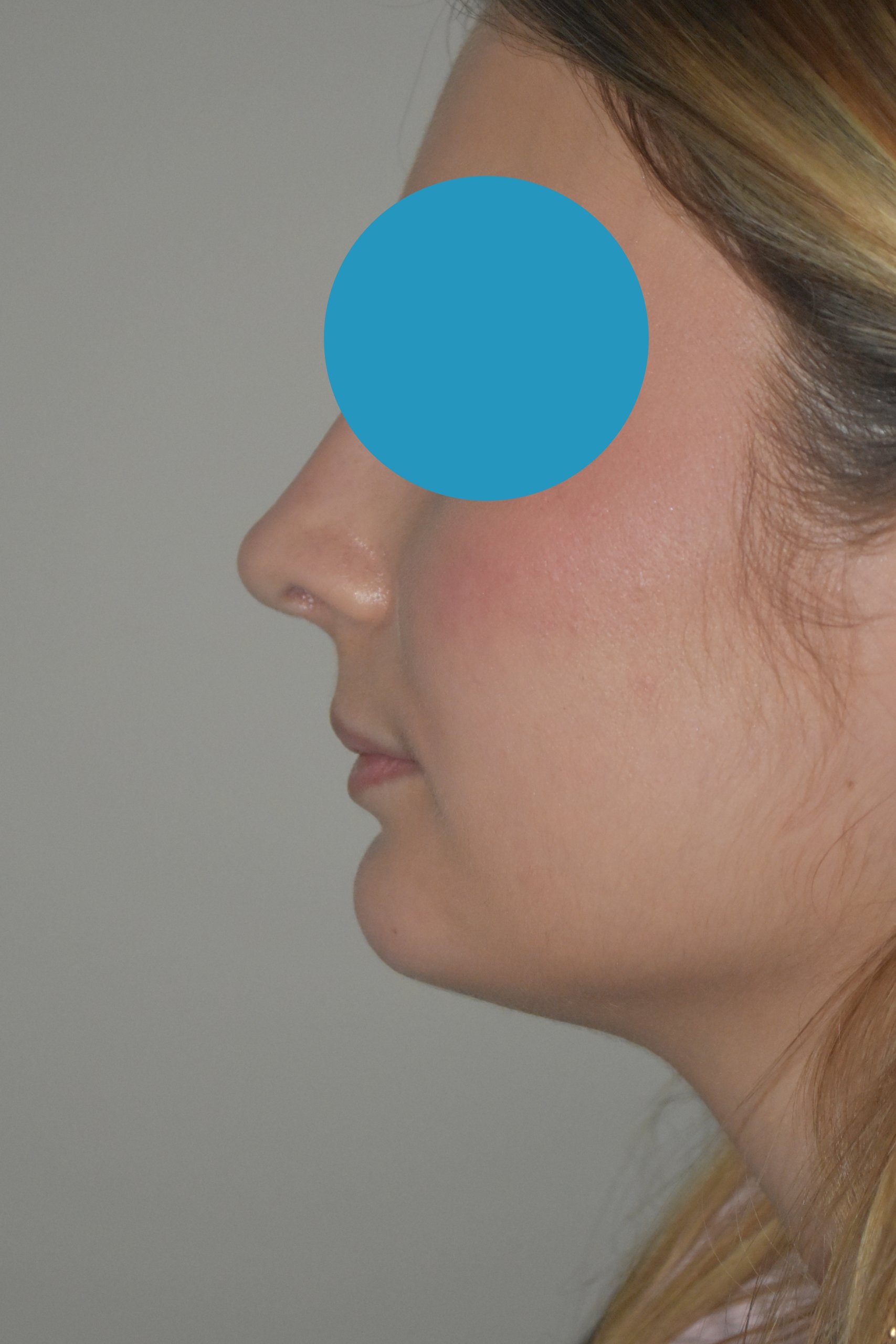 Après rhinoplastie du nez dévier