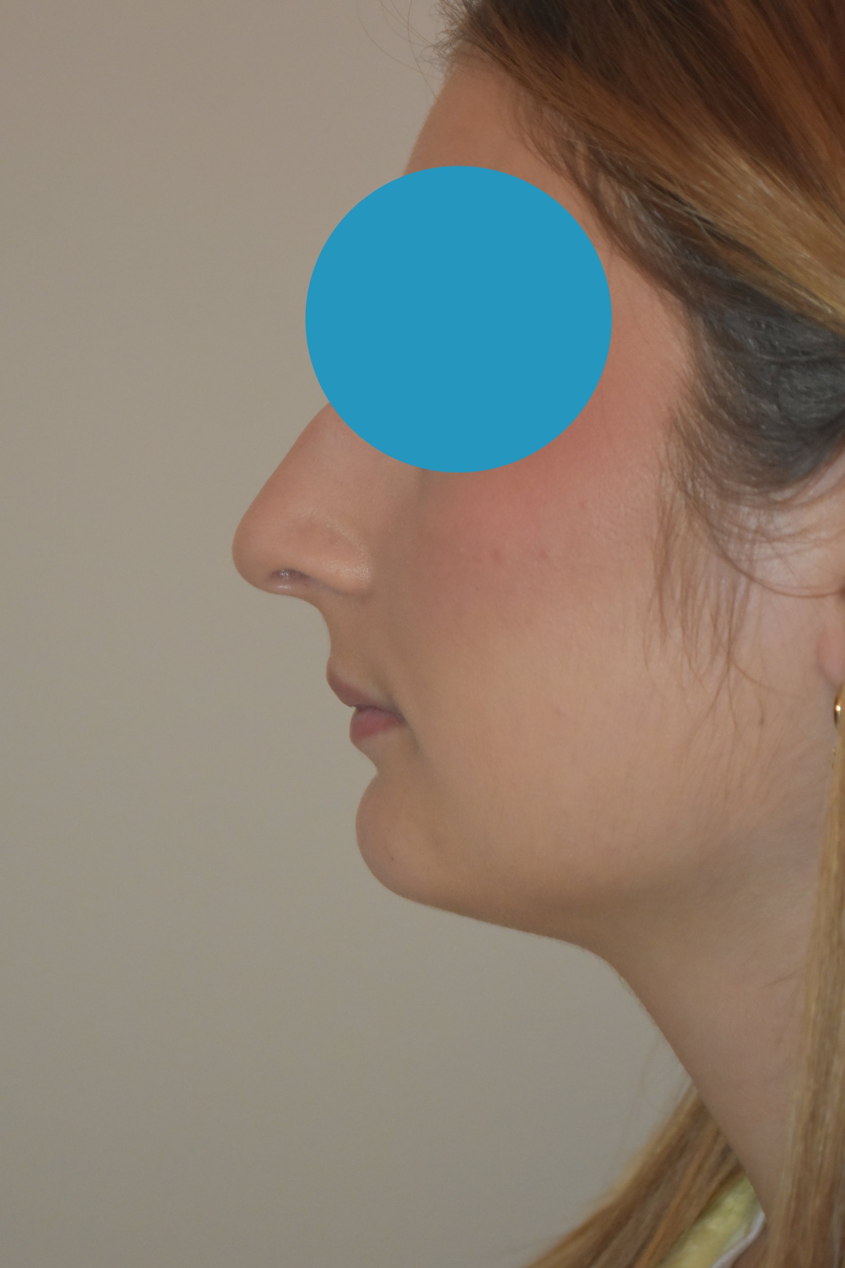 Avant rhinoplastie du nez dévier