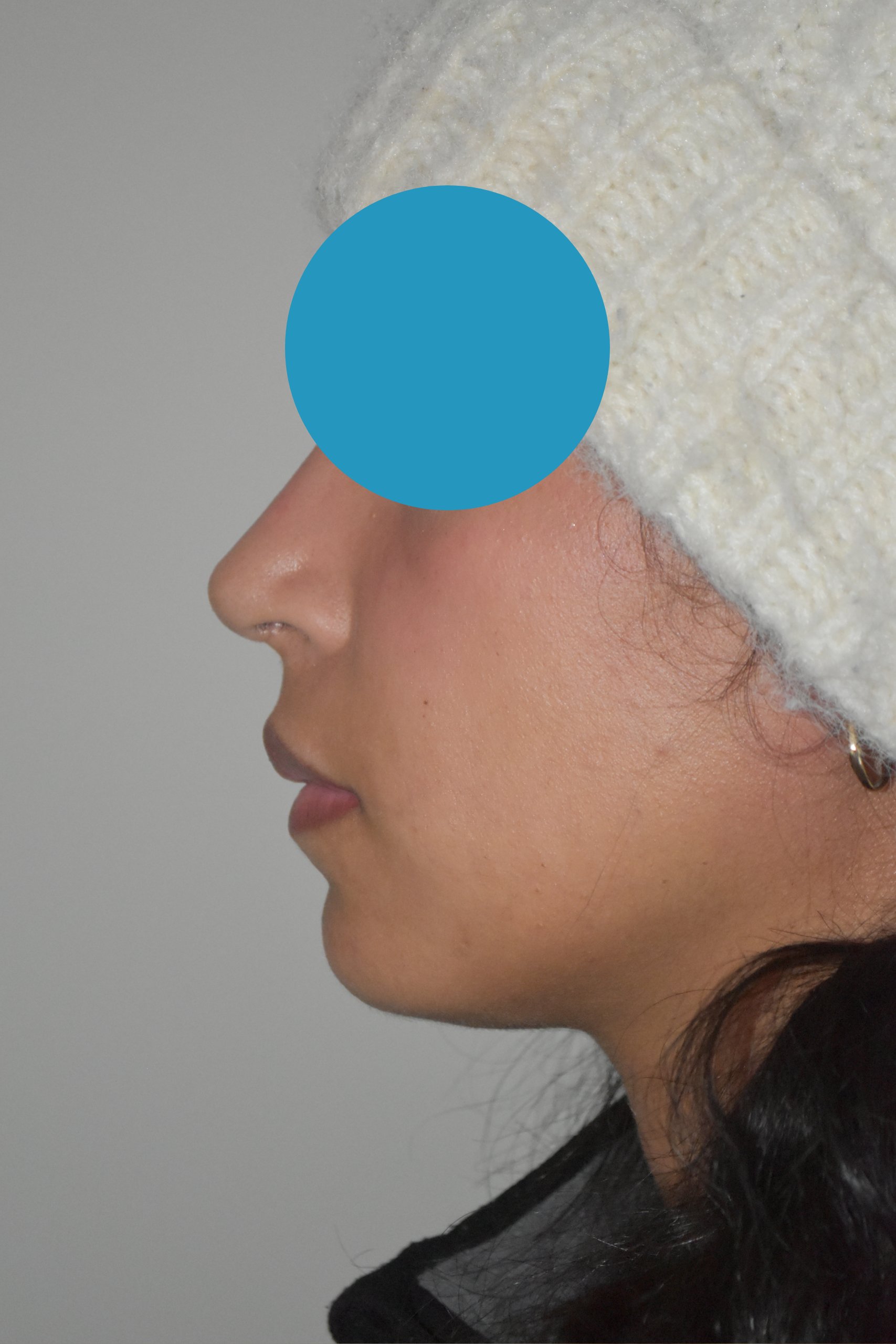 Après rhinoplastie du nez dévier