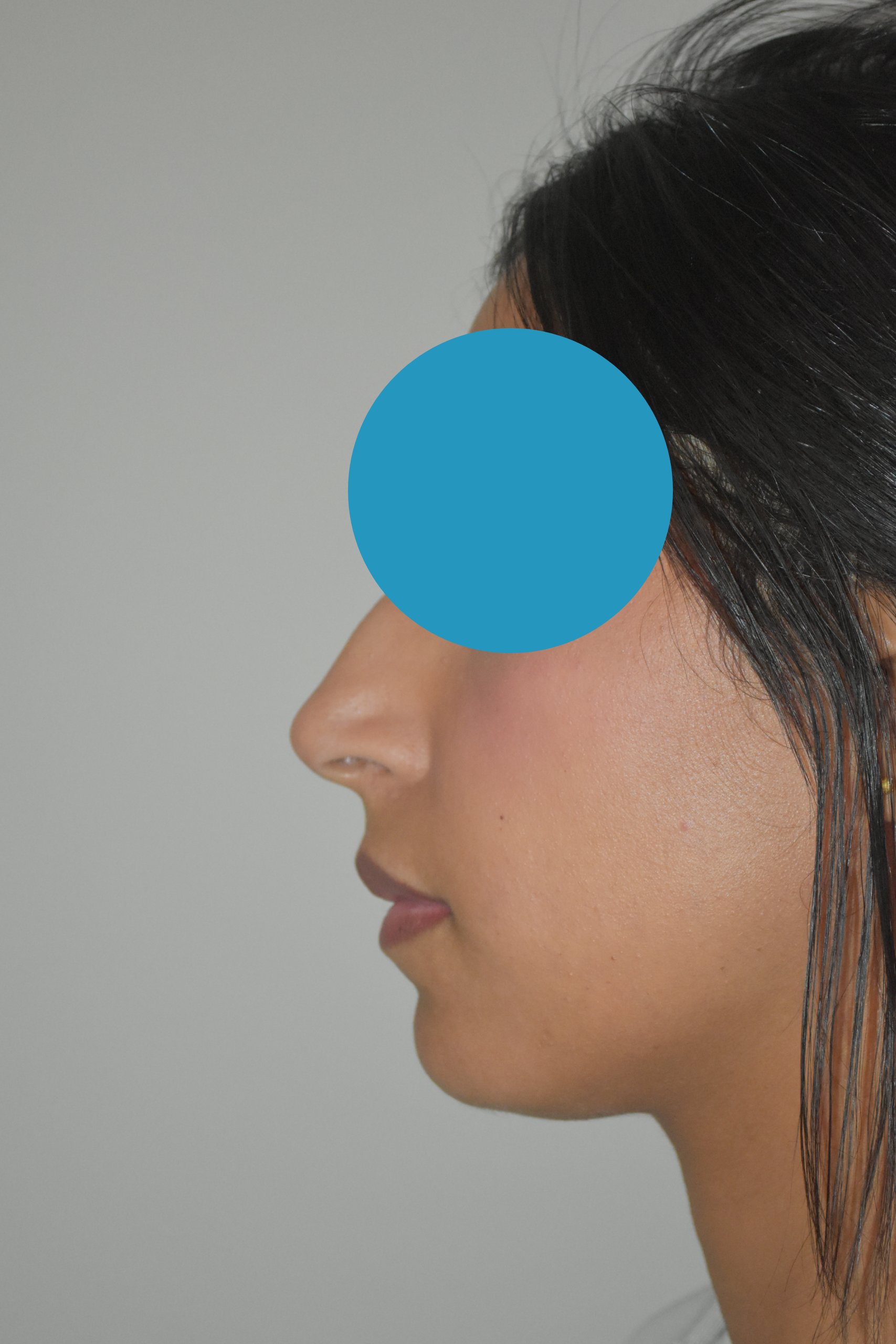 Avant rhinoplastie du nez dévier