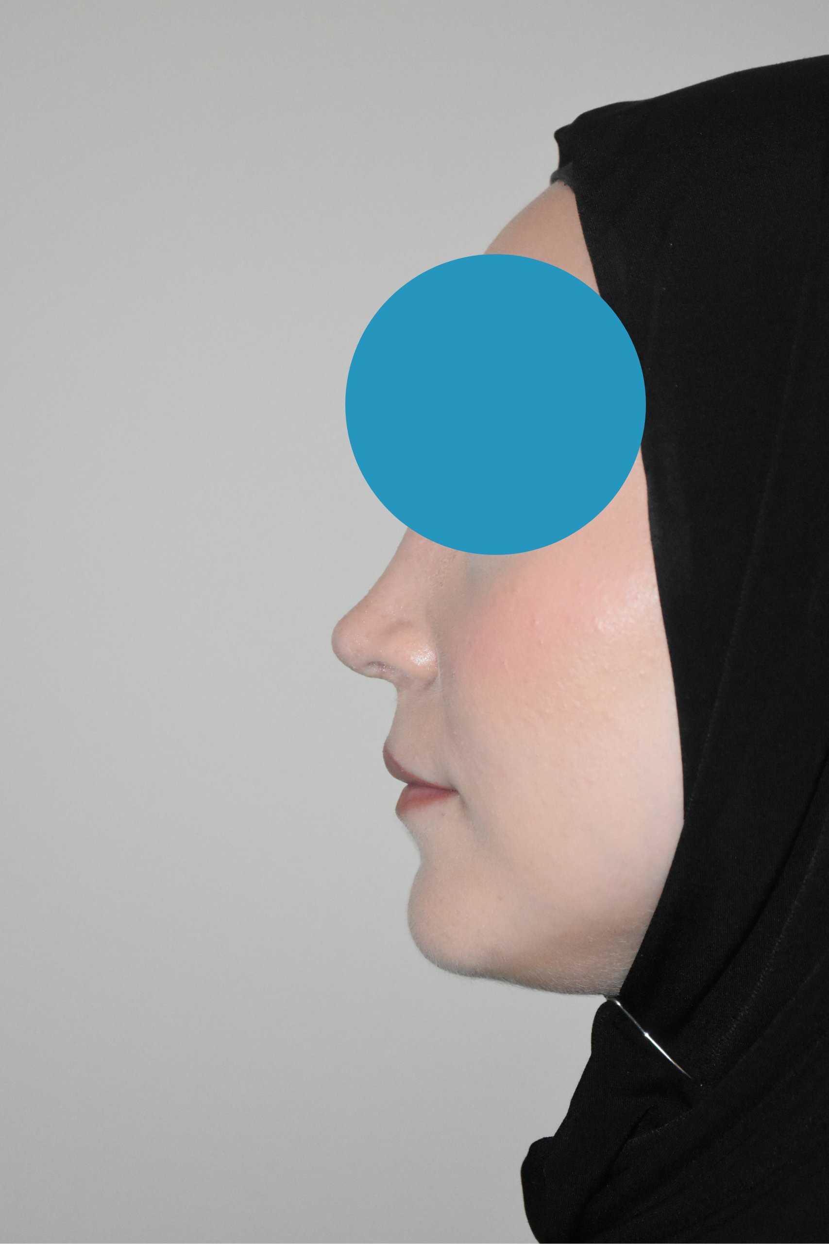 Après rhinoplastie du nez dévier