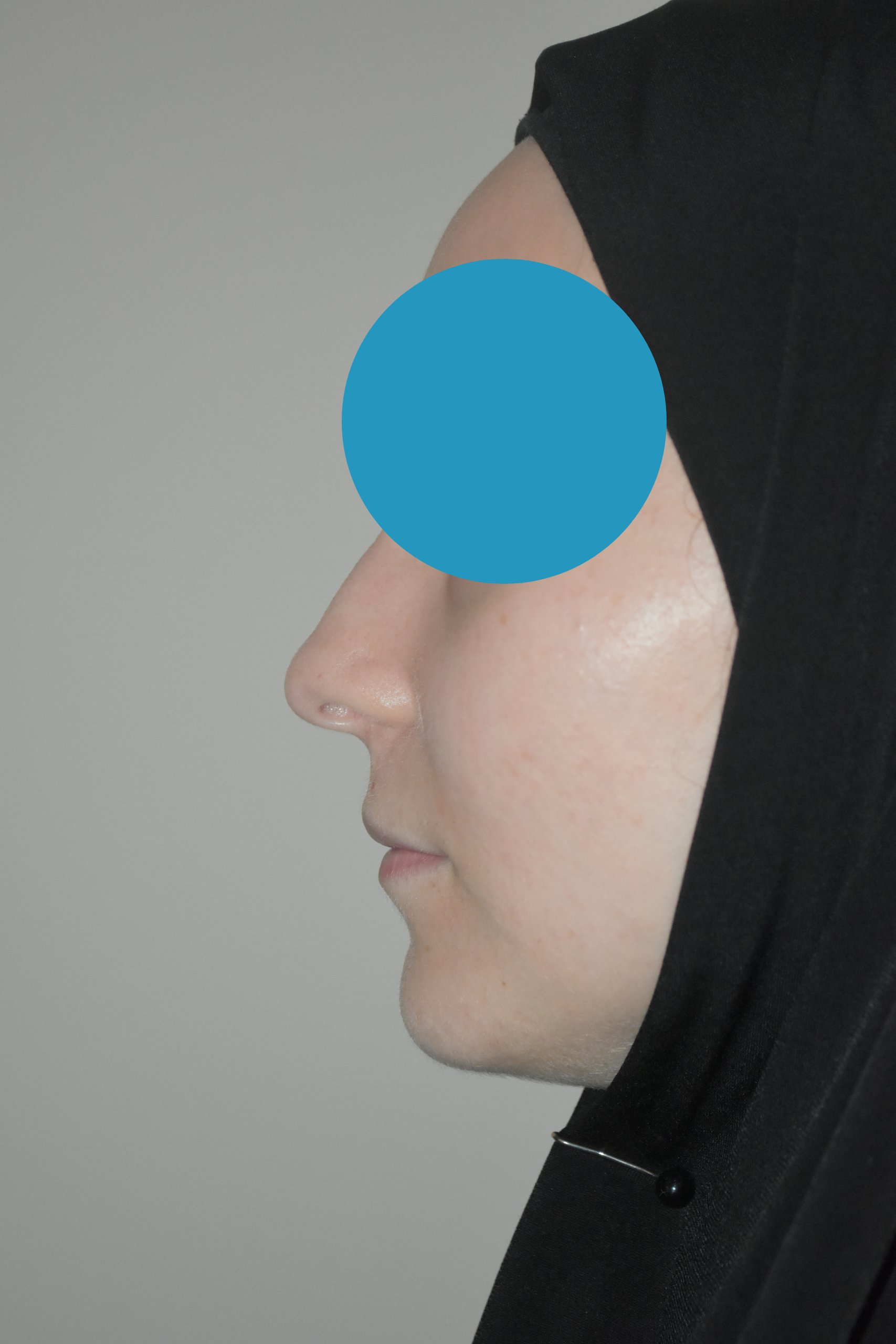 Avant rhinoplastie du nez dévier
